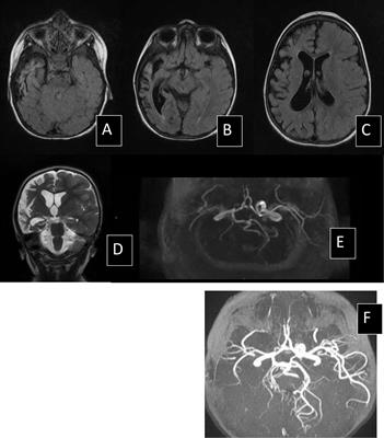 Different Clinical Presentations and Outcomes of Disseminated Varicella in Children With Primary and Acquired Immunodeficiencies